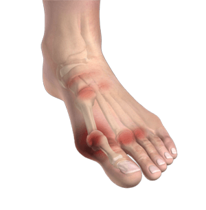 Ankle Rheumatoid Arthritis